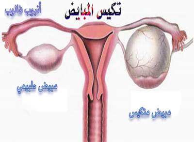 تعالوا نجتمع يالمتكيسات هنا للتفائل والامل سيغلق اي موضوع مشابه