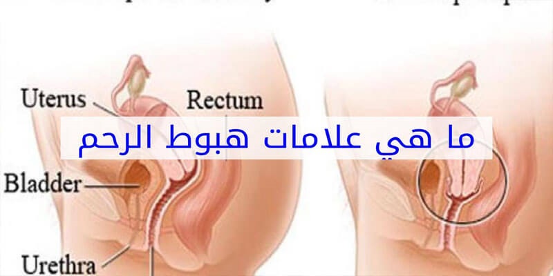 علاج نزول الرحم هنا باذن الله , امراض نسائية تصيب النساء