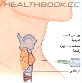 مريضات الغده الدرقية الله يشافينا , نبذه عن الغده الدرقيه