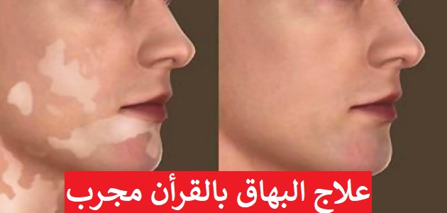 علاج البهاق بالقران مجرب - تخلص من البقع البيضاء 9264 1