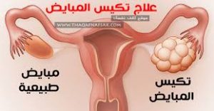 كيس 4 سم مائي على المبيض الايمن